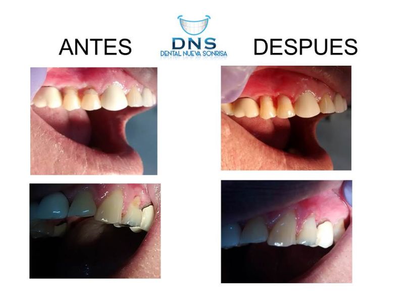 Tratamiento Dental Zihua 