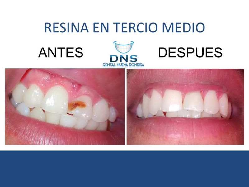 Tratamiento Dental 